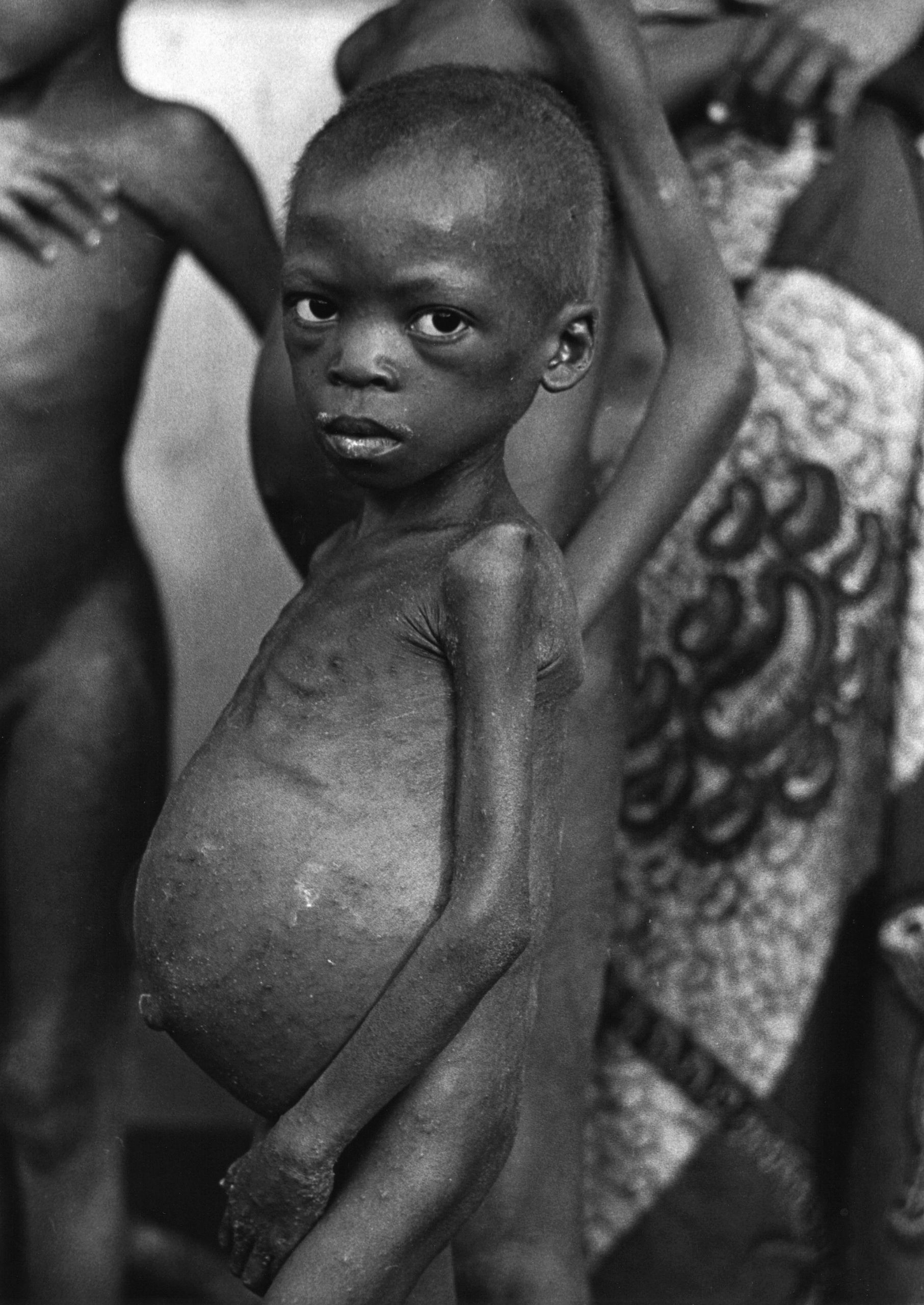 Barn ramt af hungersnød, stor mave, tynde arme, Biafra